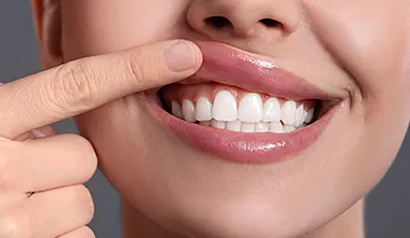 Nahaufnahme einer Patientin, die mit dem Finger ihr Zahnfleisch zeigt. Parodontologie und Behandlung von Zahnfleischerkrankungen beim Zahnarzt in Lübeck.